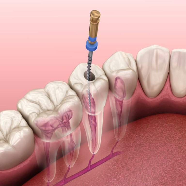 Everything to Know Before You Visit Root Canal Dentist