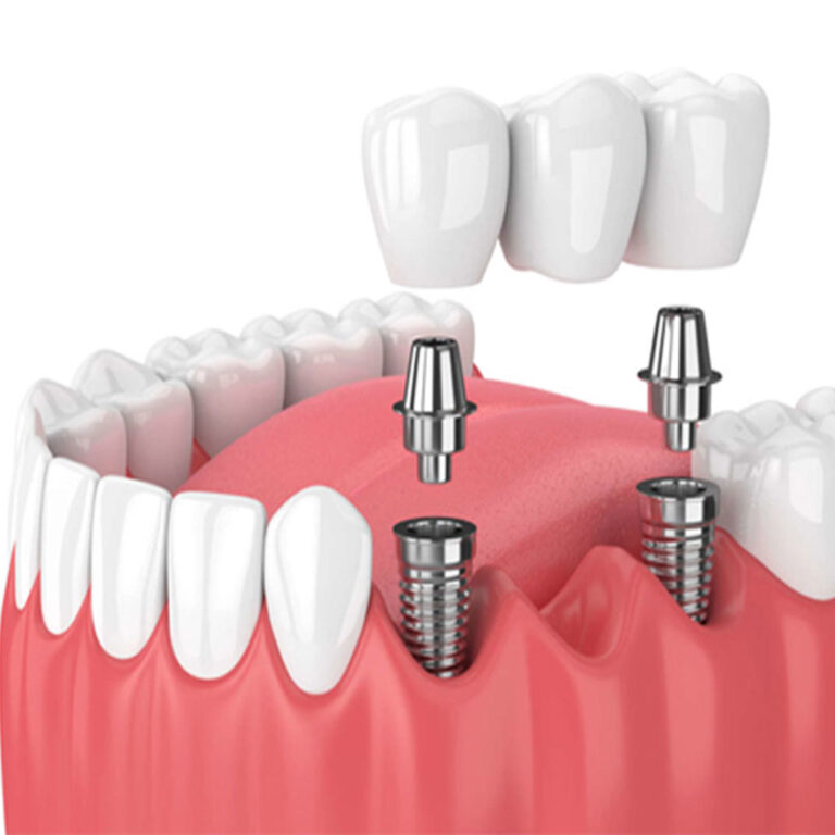 Dental Crown and Bridge treatment