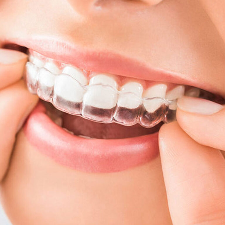 Best Teeth Aligner Specialist In Gurgaon