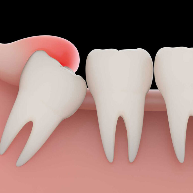 Wisdom tooth extraction recovery