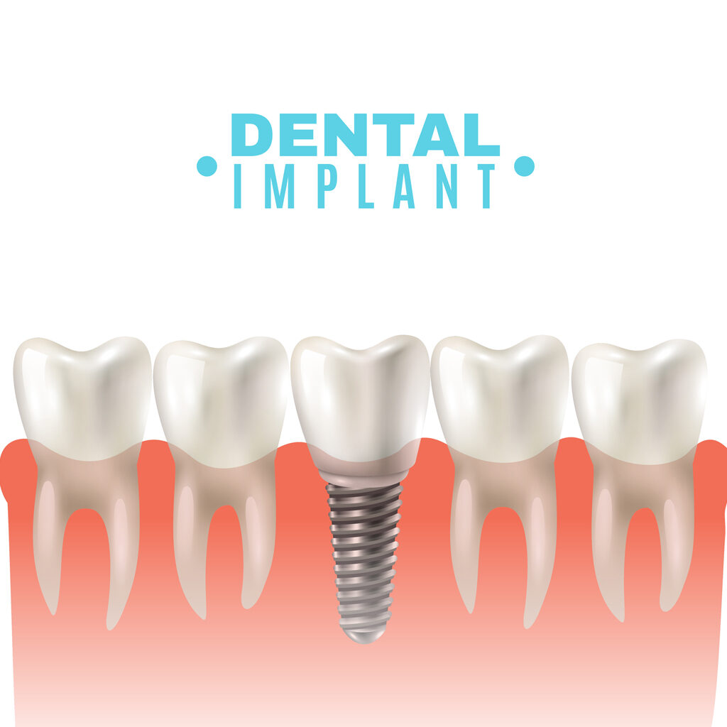 Dental implants image