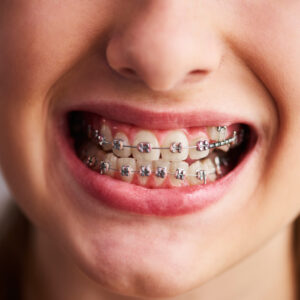 Dental braces for adult