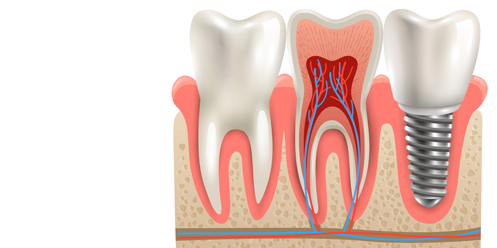 Wisdom Tooth Extraction In Gurgaon