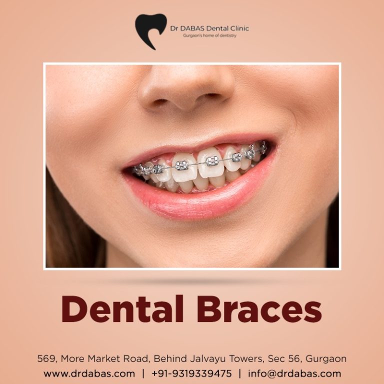 Dental Braces clinic in Gurgaon – Dr Dabas Dental Clinic