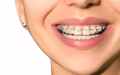 Fixed Braces Clinic In Gurgaon