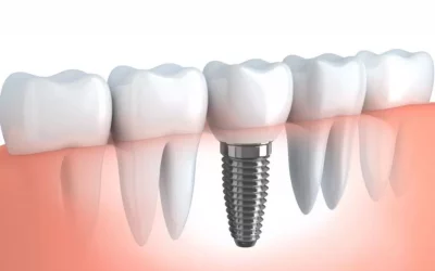 Dental-Implants