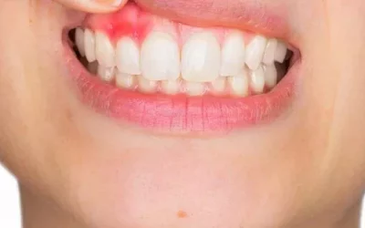 Gum Treatment Clinic In Gurgaon