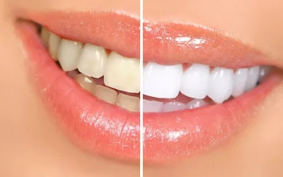 Teeth Whitening Clinic In Gurgaon