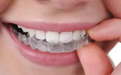 Invisible Braces clinic in gurgaon sector 56