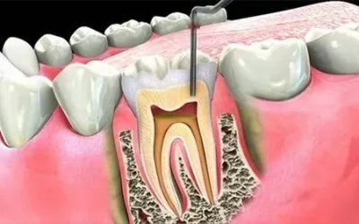 Root Canal Treatment in Gurgaon