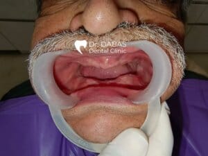 Dental implant in gurgaon