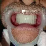 Full Mouth Rehabilitation In Gurgaon