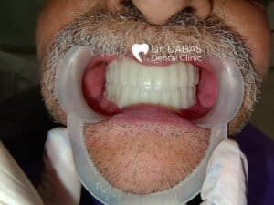 Full Mouth Rehabilitation In Gurgaon