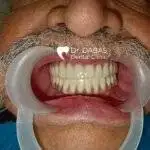 Full Mouth Rehabilitation In Gurgaon