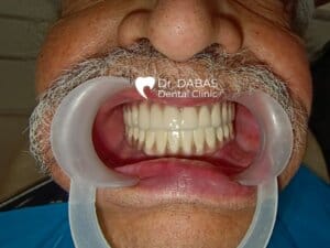 Full Mouth Rehabilitation In Gurgaon