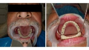 Root Canal Treatment Cost In Gurgaon