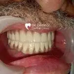 Full Mouth Rehabilitation In Gurgaon