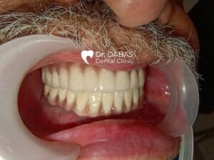 Full Mouth Rehabilitation In Gurgaon