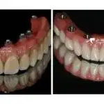 Extraction Of Tooth In Gurgaon