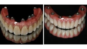 Extraction Of Tooth In Gurgaon