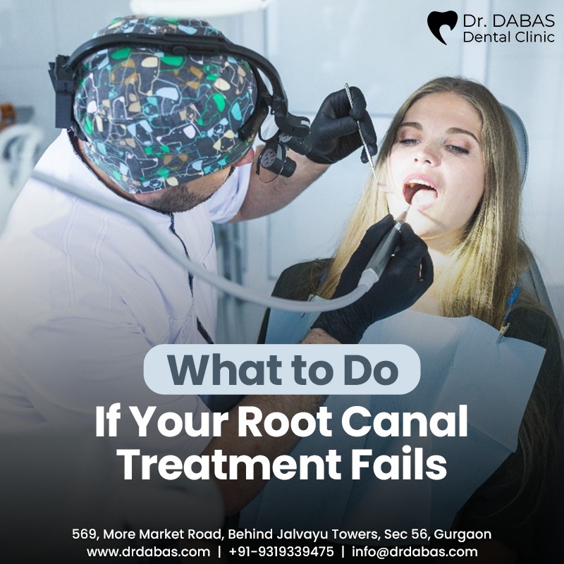 Best Root Canal Treatment in Gurgaon