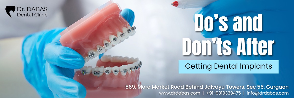 Dental Implant in Gurgaon