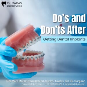 Dental implants in Gurgaon