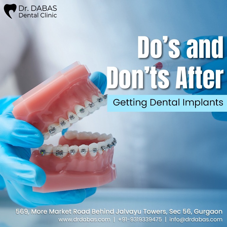 Dental implants in Gurgaon