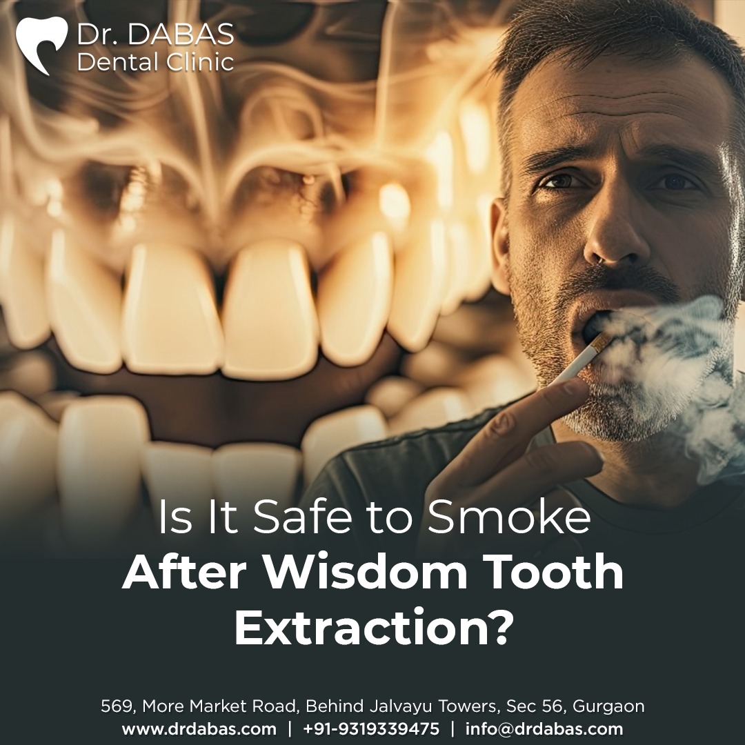 wisdom tooth extraction in Gurgaon