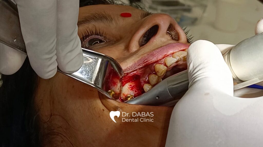 Sinus Window Membrane