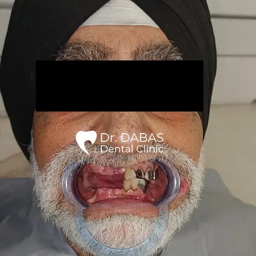 Dental implant in gurgaon