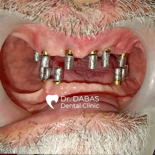 Full Mouth Dental Implants In Gurgaon