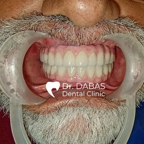 Full Mouth Rehabilitation In Gurgaon