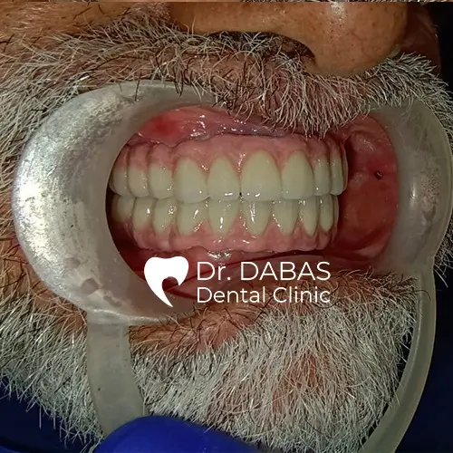 Full Mouth Rehabilitation In Gurgaon