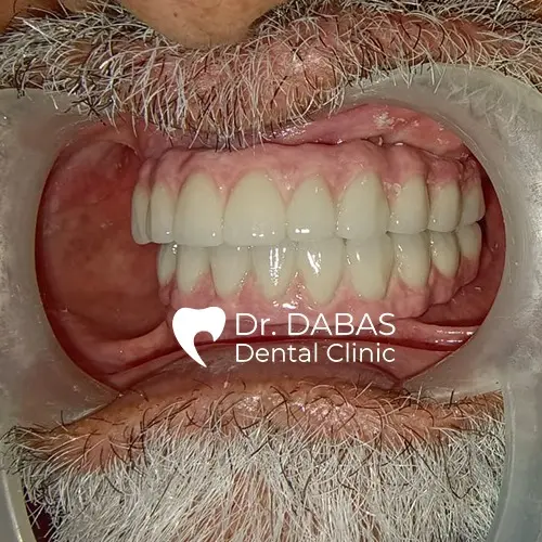 Full Mouth Rehabilitation In Gurgaon