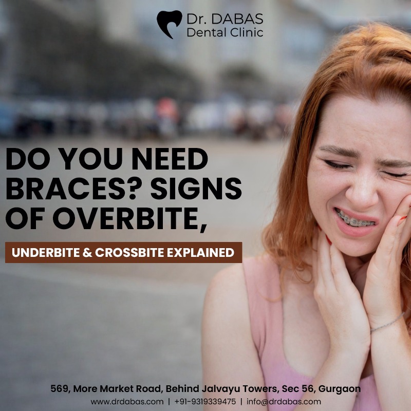 Do You Need Braces? Signs of Overbite,