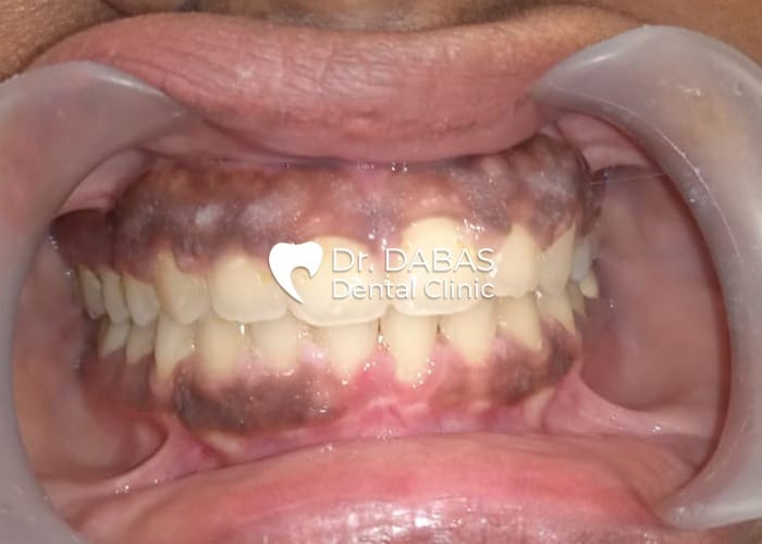 5 case post