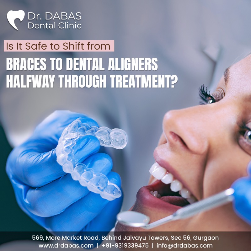 dental aligner