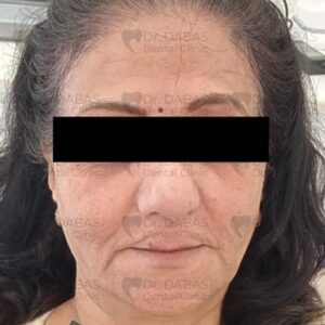 Best Dental Implants Clinic in Gurgaon Sector 56