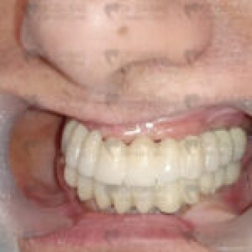 Dental Implants Post Op