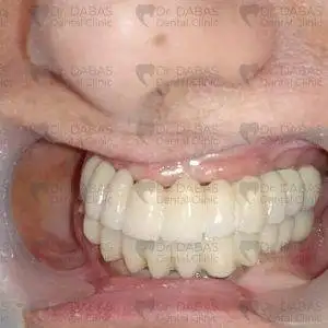 Full Mouth Dental Implants In Gurgaon