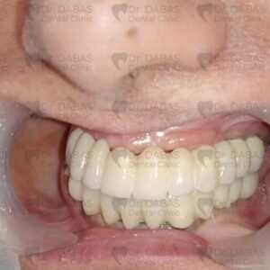 Full Mouth Dental Implants In Gurgaon