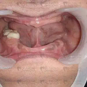 Before Dental Implants Pre Op