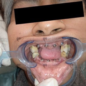 Dental Implants procedure