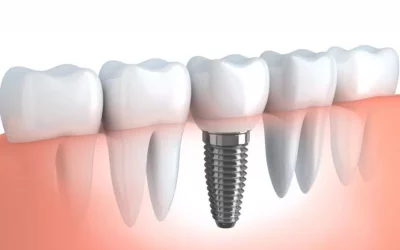 Dental-Implants-1-1