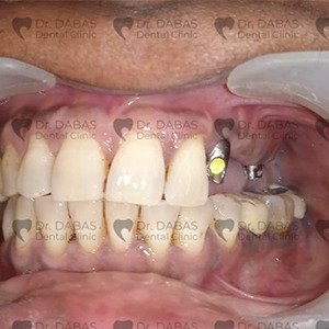Implant Supported Prosthesis