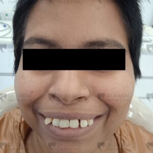 Dental Implants Post Op