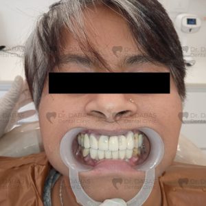 Dental Implants Post Op