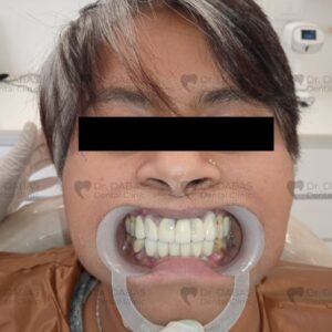 Dental Implants Pre Op