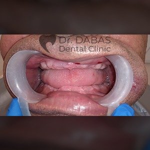 Dental Implants Pre Op